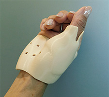 Example of a 3D printer-produced brace made with FABRIAL®